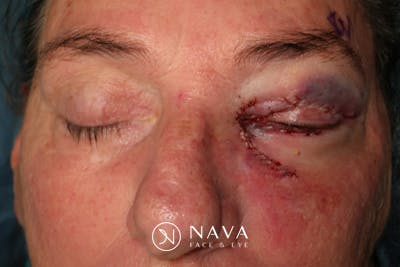 Ptosis Repair Before & After Gallery - Patient 162861 - Image 6