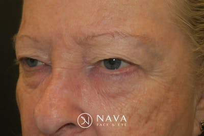 Upper Blepharoplasty (Upper Eyelid Surgery) Before & After Gallery - Patient 159344 - Image 5