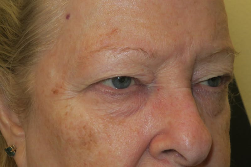 Upper Blepharoplasty (Upper Eyelid Surgery) Before & After Gallery - Patient 159344 - Image 3