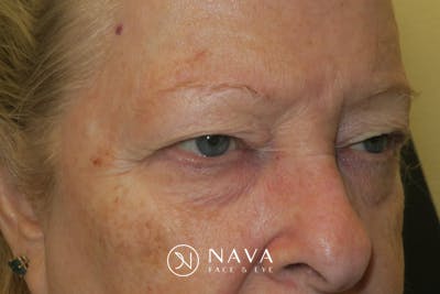 Upper Blepharoplasty (Upper Eyelid Surgery) Before & After Gallery - Patient 159344 - Image 3
