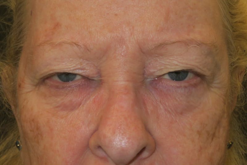 Upper Blepharoplasty (Upper Eyelid Surgery) Before & After Gallery - Patient 159344 - Image 1