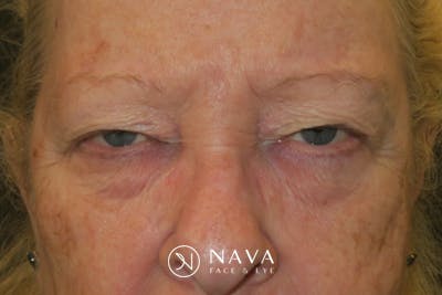 Upper Blepharoplasty (Upper Eyelid Surgery) Before & After Gallery - Patient 159344 - Image 1
