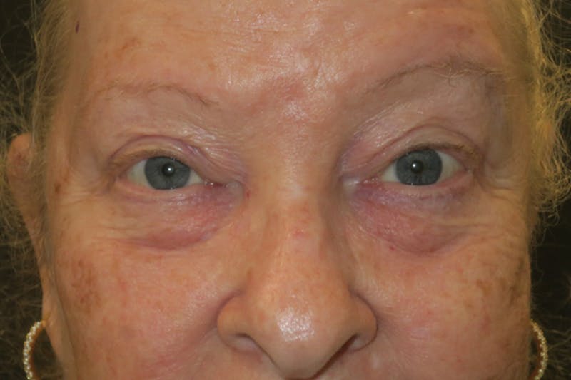 Upper Blepharoplasty (Upper Eyelid Surgery) Before & After Gallery - Patient 159344 - Image 2