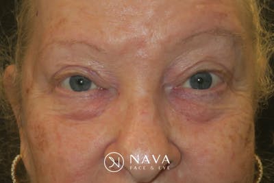 Upper Blepharoplasty (Upper Eyelid Surgery) Before & After Gallery - Patient 159344 - Image 2