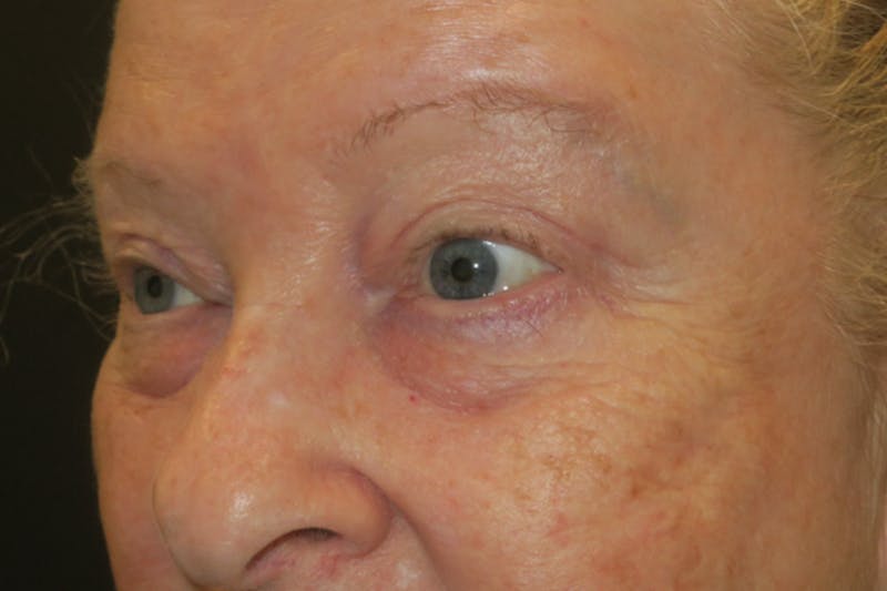 Upper Blepharoplasty (Upper Eyelid Surgery) Before & After Gallery - Patient 159344 - Image 6