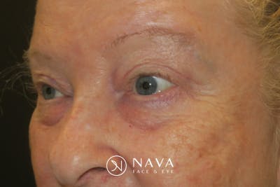 Upper Blepharoplasty (Upper Eyelid Surgery) Before & After Gallery - Patient 159344 - Image 6