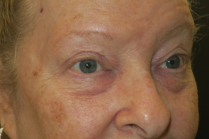 Upper Blepharoplasty (Upper Eyelid Surgery) Before & After Gallery - Patient 159344 - Image 4