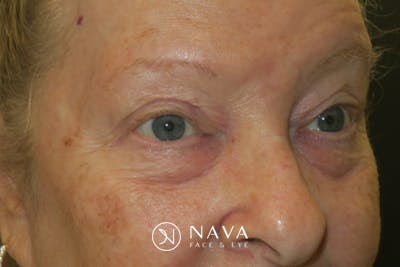 Upper Blepharoplasty (Upper Eyelid Surgery) Before & After Gallery - Patient 159344 - Image 4