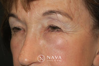 Upper Blepharoplasty (Upper Eyelid Surgery) Before & After Gallery - Patient 361875 - Image 5