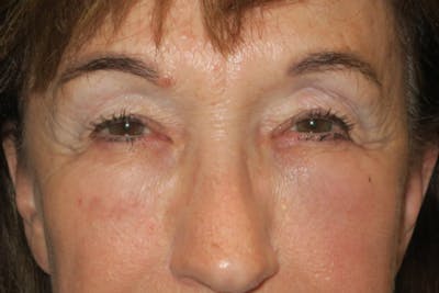 Upper Blepharoplasty (Upper Eyelid Surgery) Before & After Gallery - Patient 361875 - Image 1