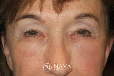 Upper Blepharoplasty (Upper Eyelid Surgery) Before & After Gallery - Patient 361875 - Image 1