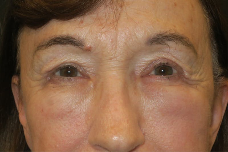Upper Blepharoplasty (Upper Eyelid Surgery) Before & After Gallery - Patient 361875 - Image 2