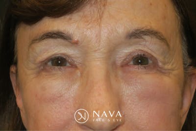 Upper Blepharoplasty (Upper Eyelid Surgery) Before & After Gallery - Patient 361875 - Image 2