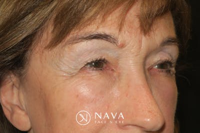 Upper Blepharoplasty (Upper Eyelid Surgery) Before & After Gallery - Patient 361875 - Image 3