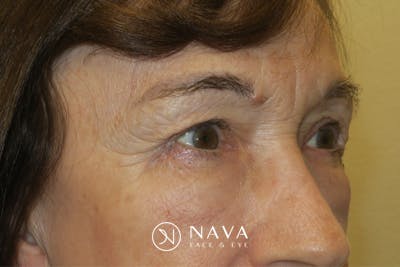 Upper Blepharoplasty (Upper Eyelid Surgery) Before & After Gallery - Patient 361875 - Image 4