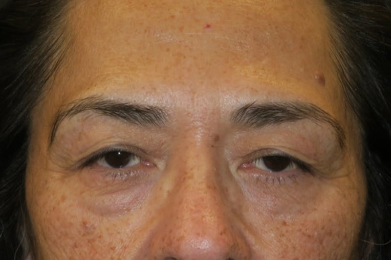 Lower Blepharoplasty (Lower Eyelid Surgery) Before & After Gallery - Patient 281934 - Image 1