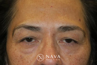 Lower Blepharoplasty (Lower Eyelid Surgery) Before & After Gallery - Patient 281934 - Image 1