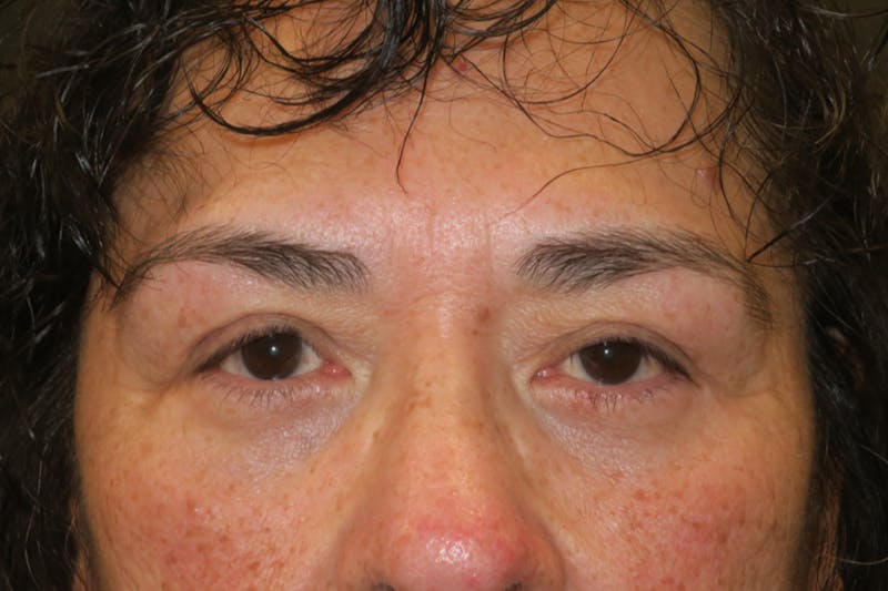 Lower Blepharoplasty (Lower Eyelid Surgery) Before & After Gallery - Patient 281934 - Image 2