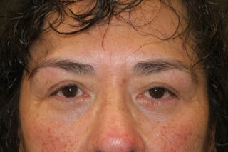 Lower Blepharoplasty (Lower Eyelid Surgery) Before & After Gallery - Patient 281934 - Image 2