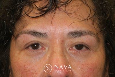 Lower Blepharoplasty (Lower Eyelid Surgery) Before & After Gallery - Patient 281934 - Image 2