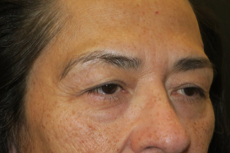 Lower Blepharoplasty (Lower Eyelid Surgery) Before & After Gallery - Patient 281934 - Image 3