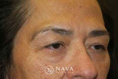 Lower Blepharoplasty (Lower Eyelid Surgery) Before & After Gallery - Patient 281934 - Image 3