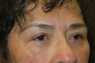 Lower Blepharoplasty (Lower Eyelid Surgery) Before & After Gallery - Patient 281934 - Image 4