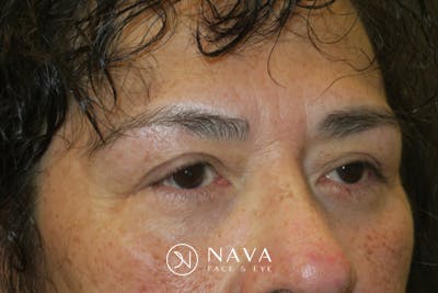 Lower Blepharoplasty (Lower Eyelid Surgery) Before & After Gallery - Patient 281934 - Image 4