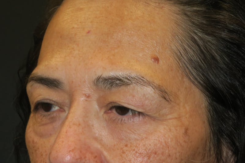 Lower Blepharoplasty (Lower Eyelid Surgery) Before & After Gallery - Patient 281934 - Image 5