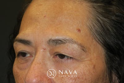 Lower Blepharoplasty (Lower Eyelid Surgery) Before & After Gallery - Patient 281934 - Image 5