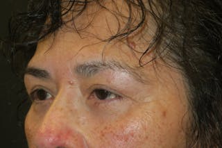 Lower Blepharoplasty (Lower Eyelid Surgery) Before & After Gallery - Patient 281934 - Image 6