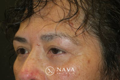 Lower Blepharoplasty (Lower Eyelid Surgery) Before & After Gallery - Patient 281934 - Image 6