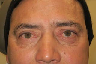 Lower Blepharoplasty (Lower Eyelid Surgery) Before & After Gallery - Patient 265868 - Image 2