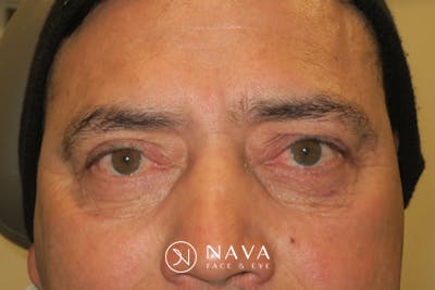 Lower Blepharoplasty (Lower Eyelid Surgery) Before & After Gallery - Patient 265868 - Image 2