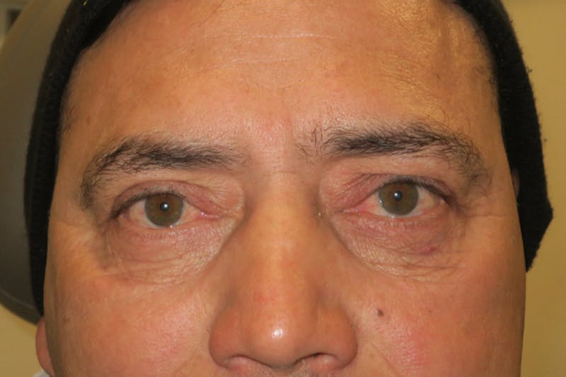 Lower Blepharoplasty (Lower Eyelid Surgery) Before & After Gallery - Patient 265868 - Image 2