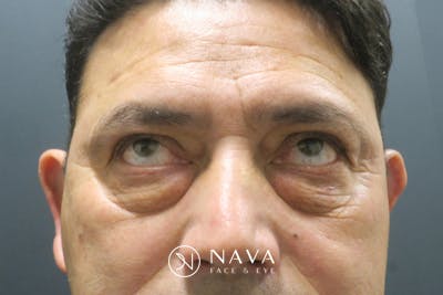 Lower Blepharoplasty (Lower Eyelid Surgery) Before & After Gallery - Patient 265868 - Image 3