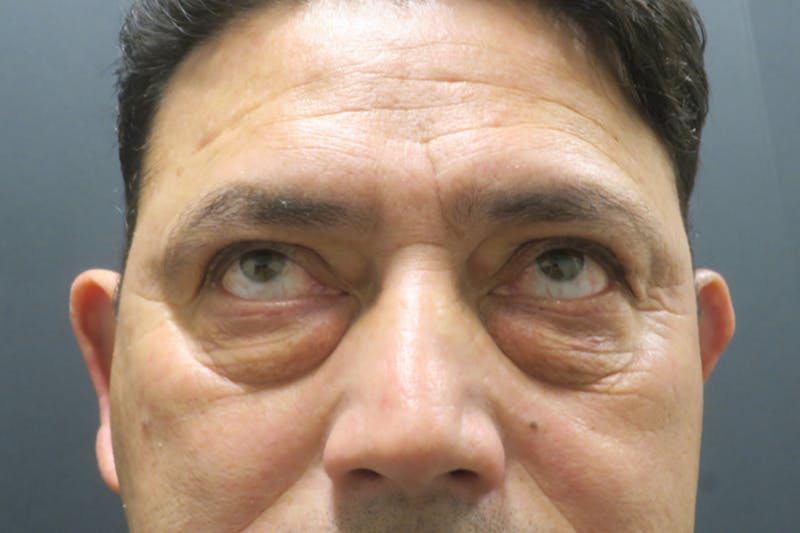 Lower Blepharoplasty (Lower Eyelid Surgery) Before & After Gallery - Patient 265868 - Image 3