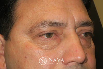 Lower Blepharoplasty (Lower Eyelid Surgery) Before & After Gallery - Patient 265868 - Image 5