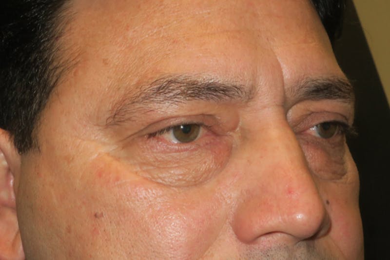 Lower Blepharoplasty (Lower Eyelid Surgery) Before & After Gallery - Patient 265868 - Image 5