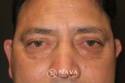Lower Blepharoplasty (Lower Eyelid Surgery) Before & After Gallery - Patient 265868 - Image 1