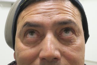 Lower Blepharoplasty (Lower Eyelid Surgery) Before & After Gallery - Patient 265868 - Image 4