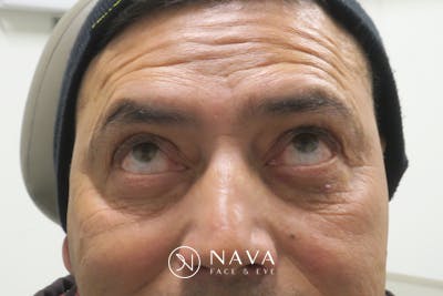 Lower Blepharoplasty (Lower Eyelid Surgery) Before & After Gallery - Patient 265868 - Image 4