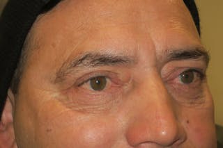Lower Blepharoplasty (Lower Eyelid Surgery) Before & After Gallery - Patient 265868 - Image 6