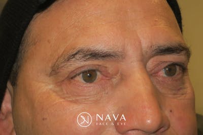 Lower Blepharoplasty (Lower Eyelid Surgery) Before & After Gallery - Patient 265868 - Image 6