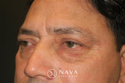 Lower Blepharoplasty (Lower Eyelid Surgery) Before & After Gallery - Patient 265868 - Image 7