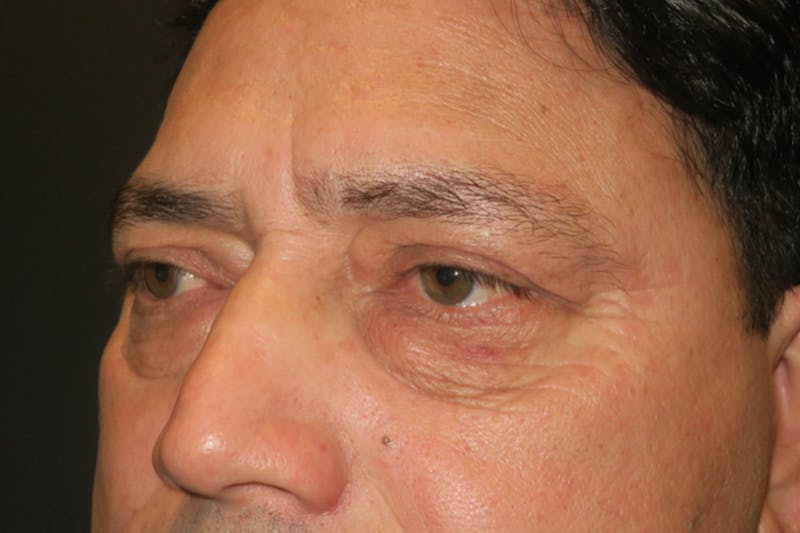 Lower Blepharoplasty (Lower Eyelid Surgery) Before & After Gallery - Patient 265868 - Image 7