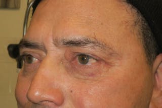 Lower Blepharoplasty (Lower Eyelid Surgery) Before & After Gallery - Patient 265868 - Image 8