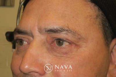 Lower Blepharoplasty (Lower Eyelid Surgery) Before & After Gallery - Patient 265868 - Image 8