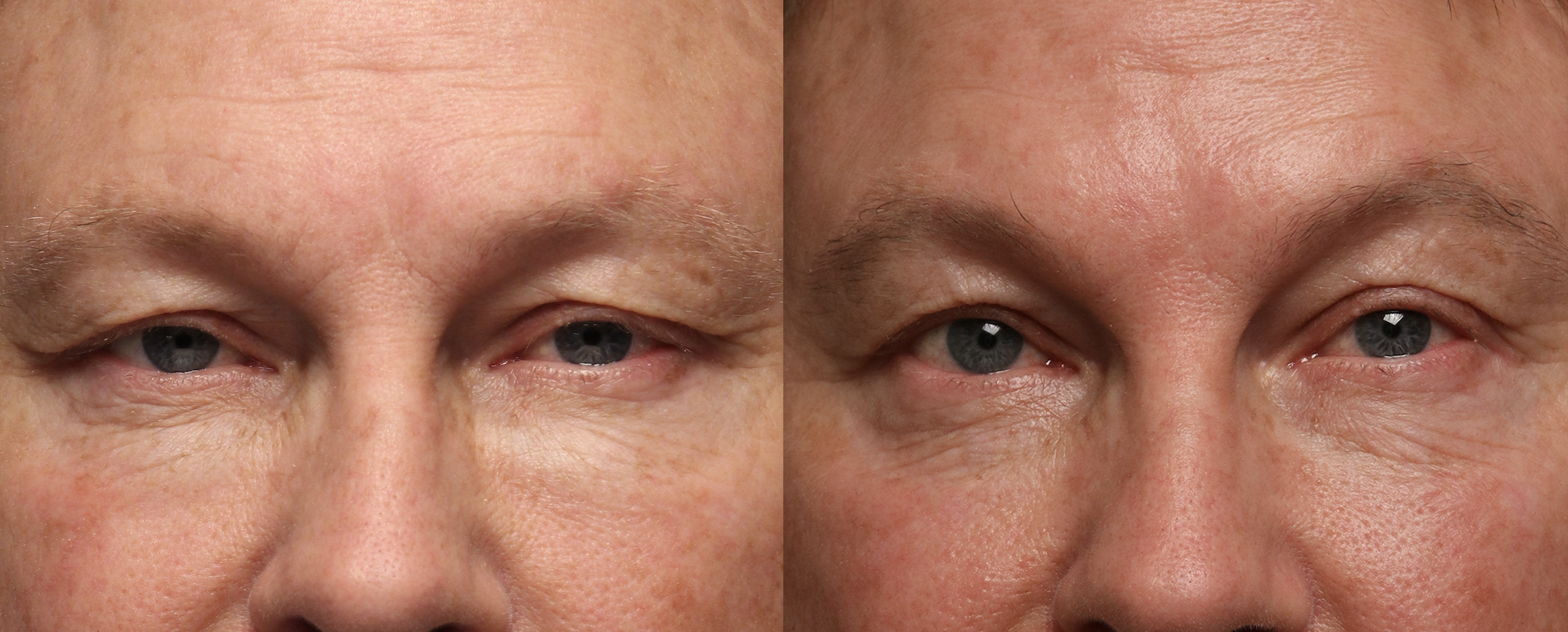 before and after image of a patient's eyes after morpheus8 treatment
