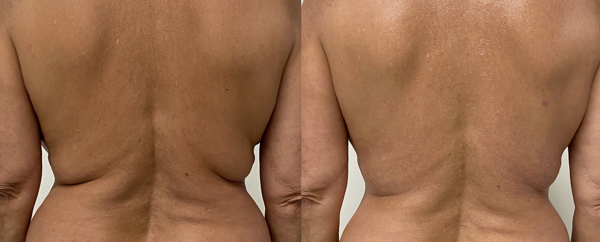 before and after image of a patients back